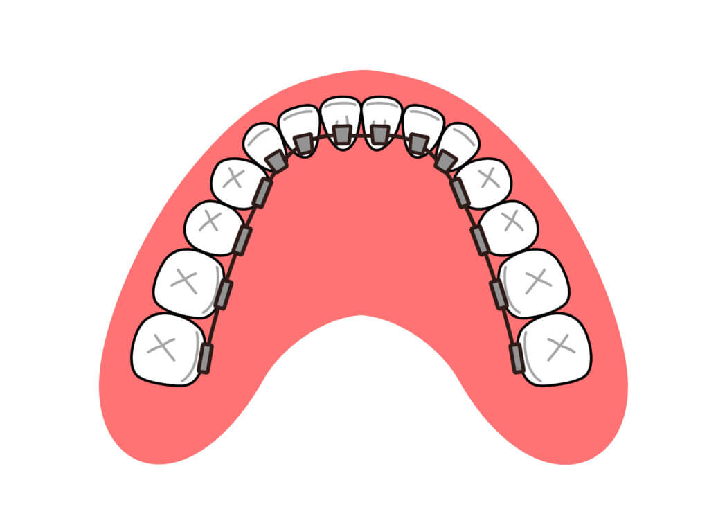 リンガルブラケット(裏側矯正)のイラスト