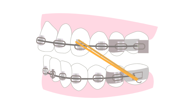 エラスティックゴムを使用した矯正治療の側面からのイラスト