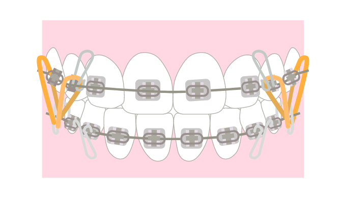 エラスティックゴムを使用した矯正治療の前面からのイラスト