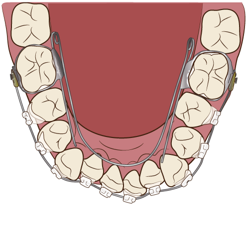 リンガルアーチ＆ワイヤーの装着