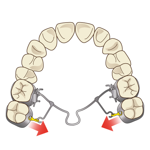 改良されたパラタルアーチ装置が奥歯を動かす方向
