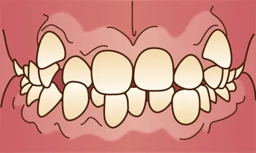 歯並びが悪いと歯磨きの難易度が上がる