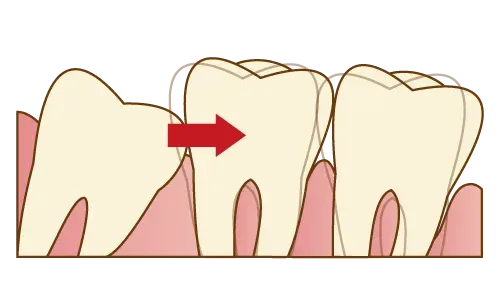 親知らずが歯並びに悪い影響を及ぼす